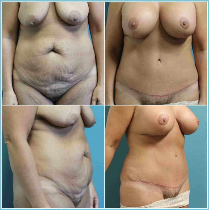 Abdominoplasty (Tummy Tuck) before and after result