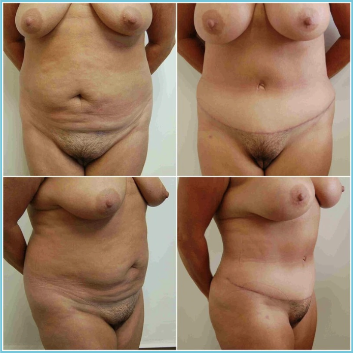 Abdominoplasty (Tummy Tuck) before and after result