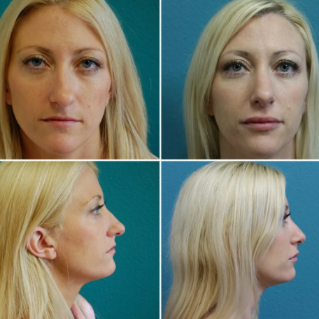 Before and after result