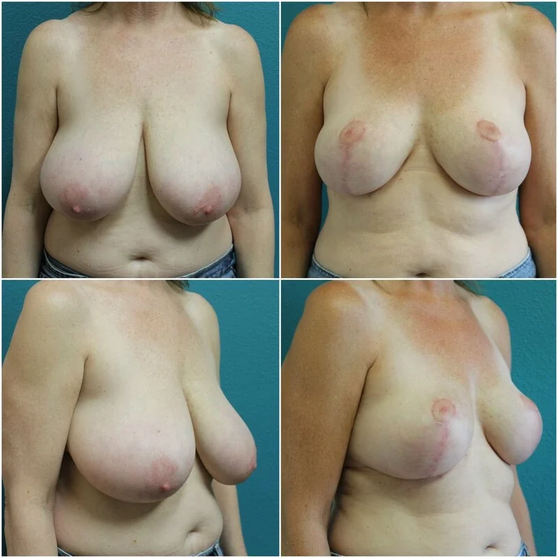 Before and After Breast Reduction
