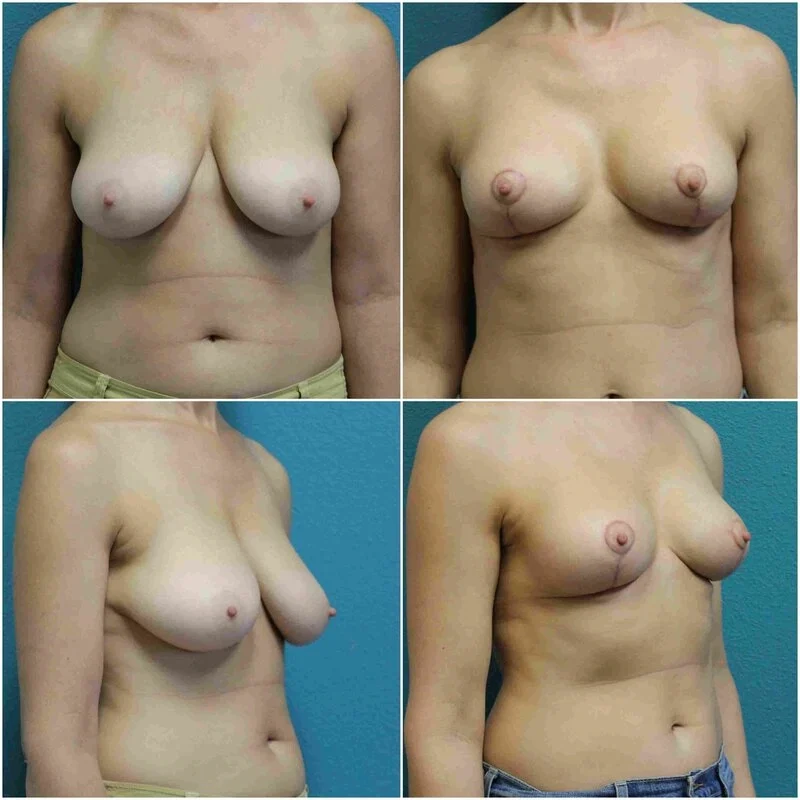 Before and After Breast Reduction
