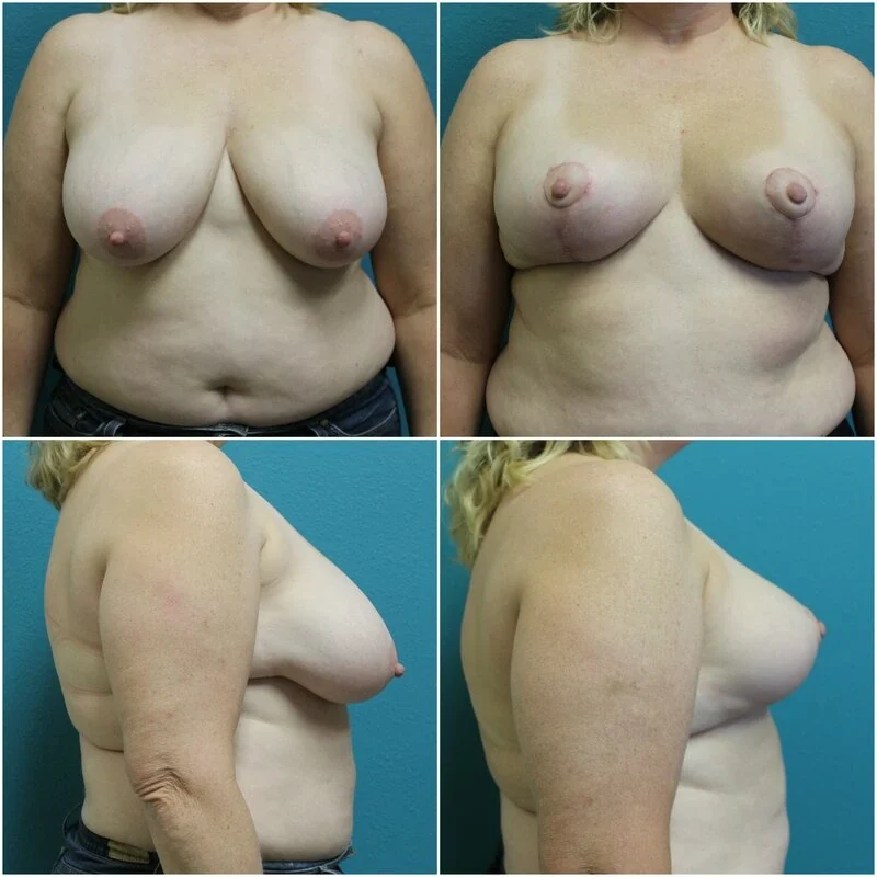 Before and After Breast Reduction