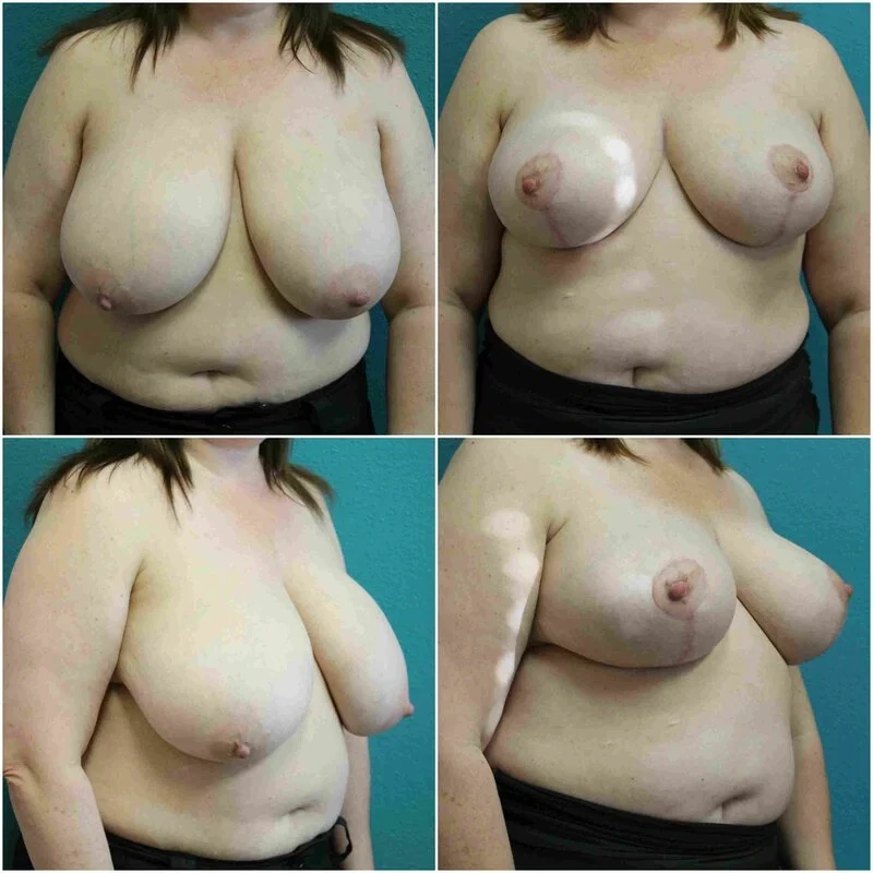Before and After Breast Reduction