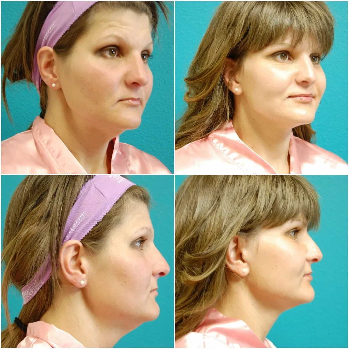Before and After Facelift b