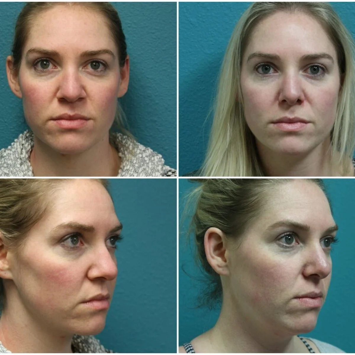 Before and After Rhinoplasty
