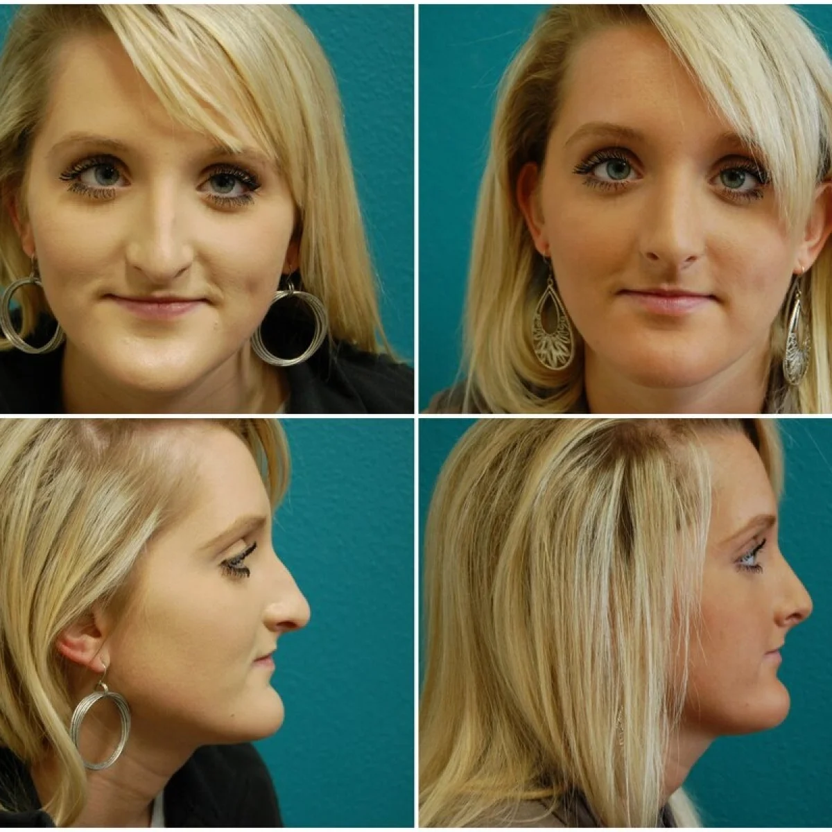 Before and After Rhinoplasty