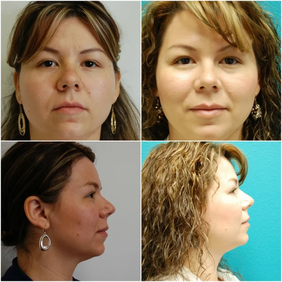 Before and After Rhinoplasty