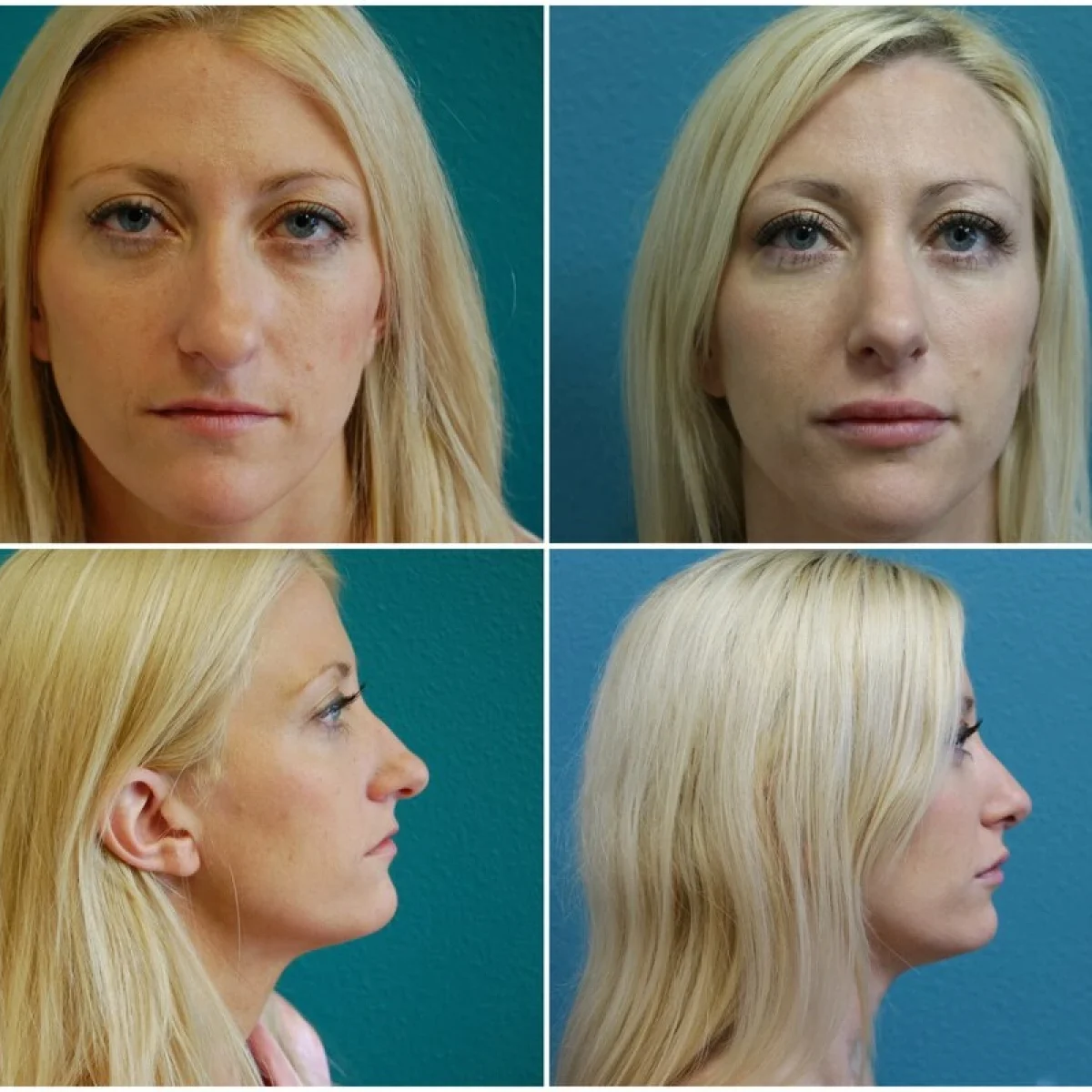 Before and After Rhinoplasty