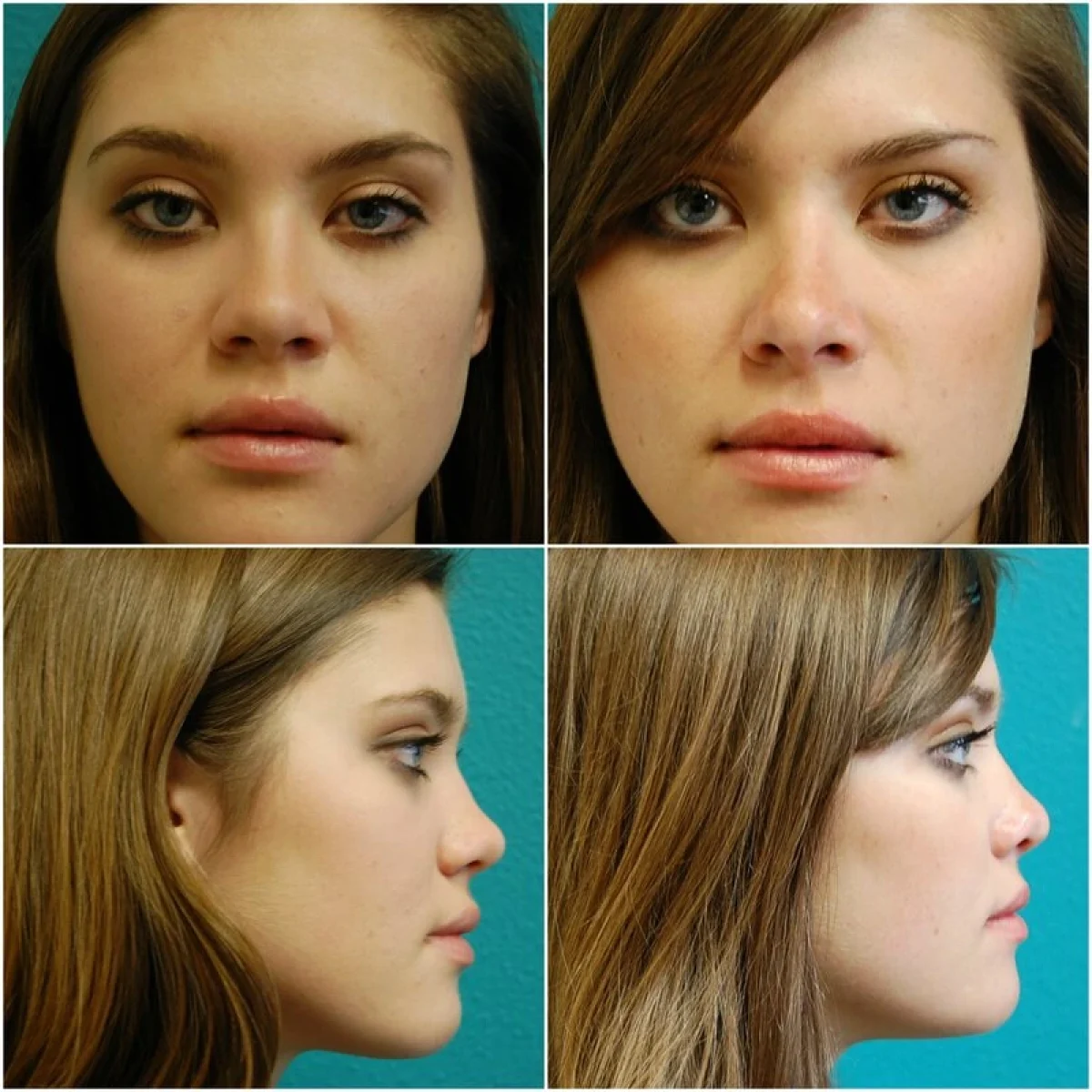 Before and After Rhinoplasty