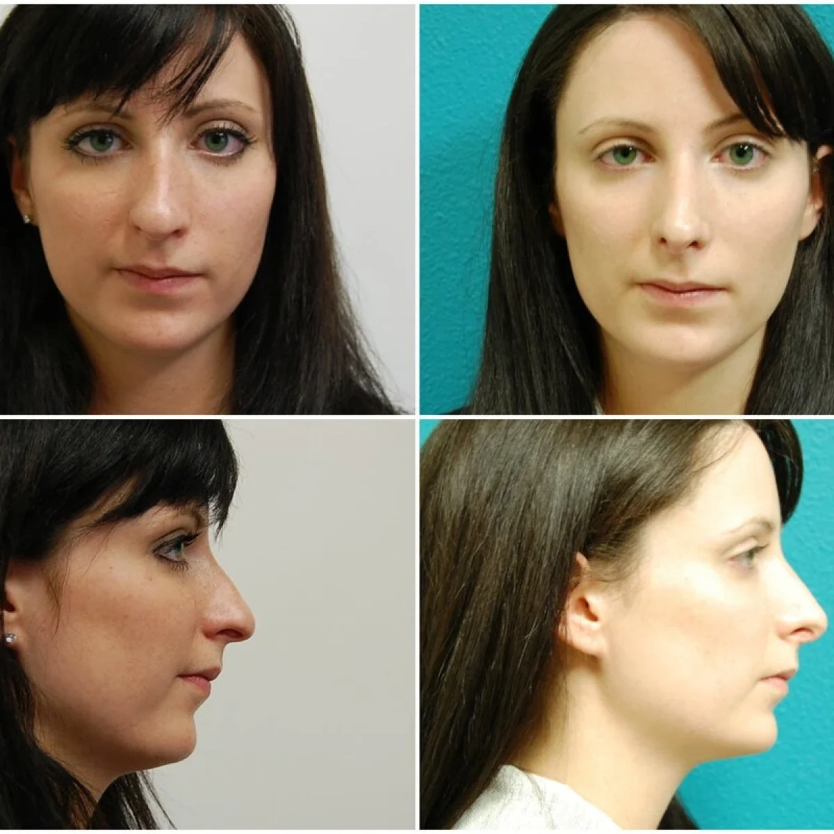 Before and After Rhinoplasty