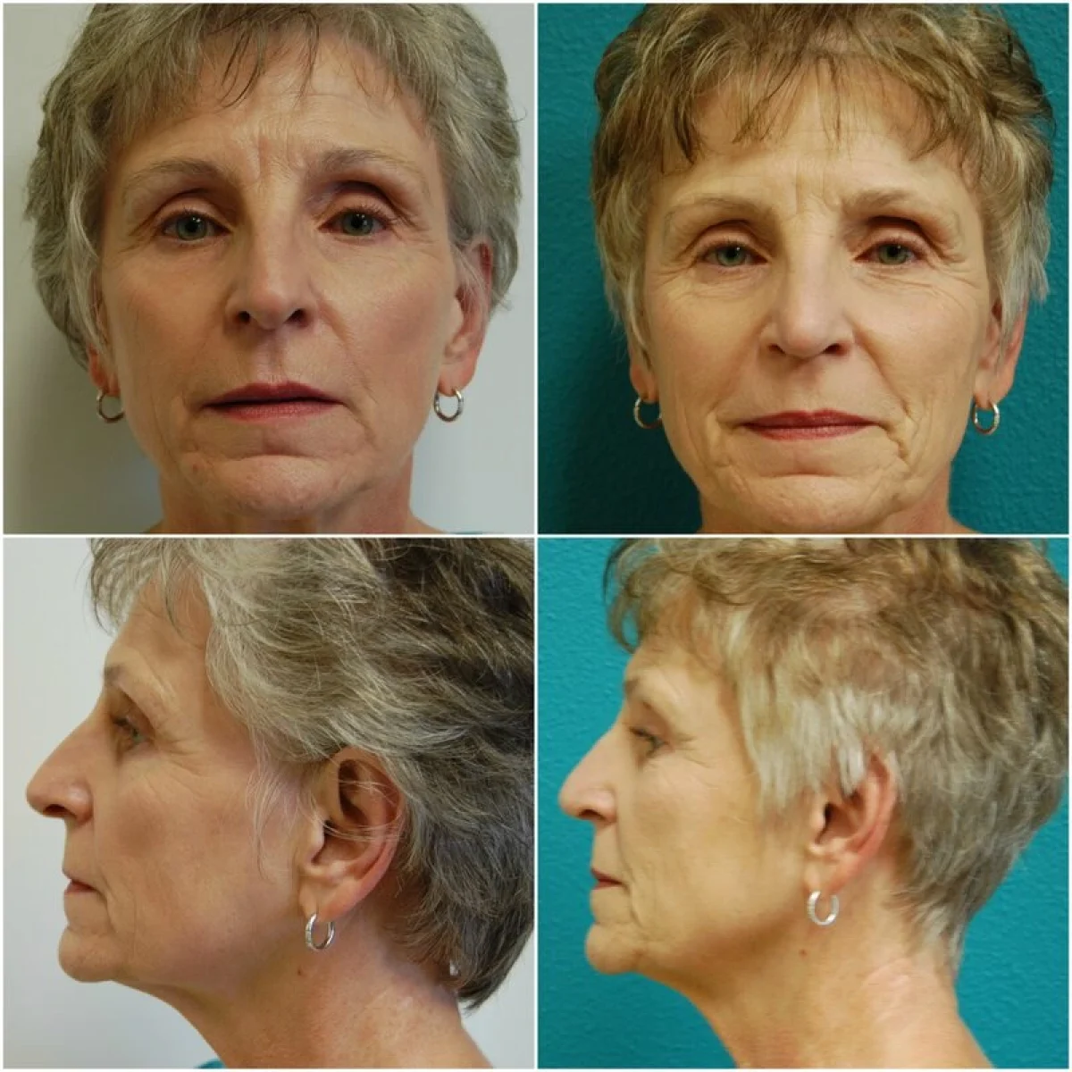 Before and After Rhinoplasty