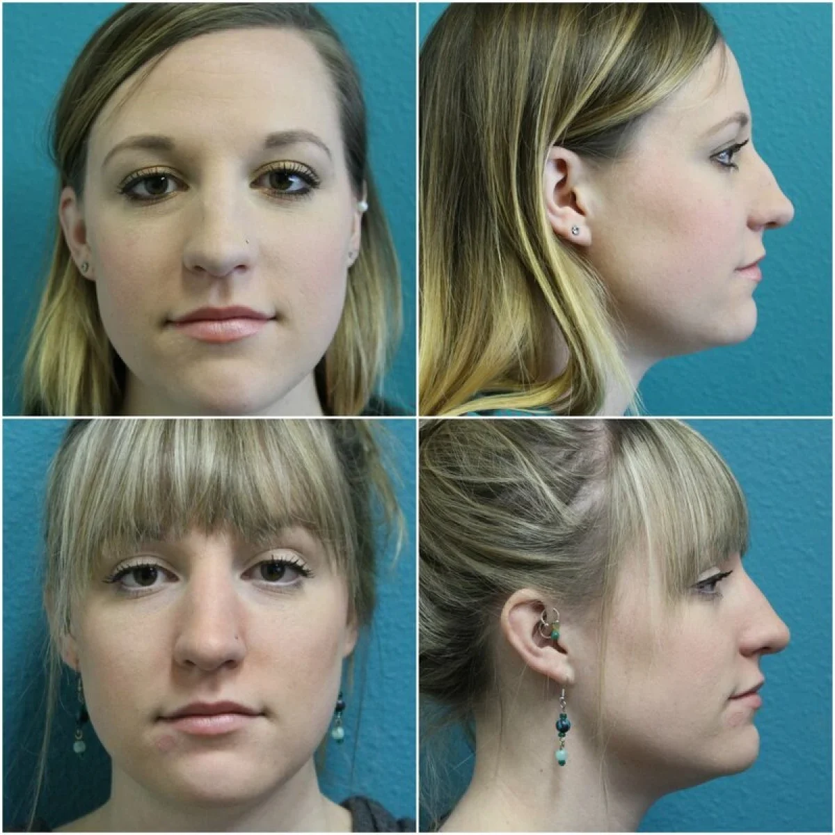 Before and After Rhinoplasty