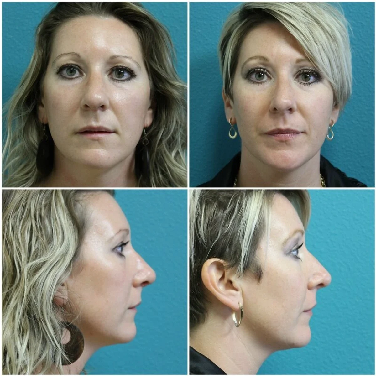 Before and After Rhinoplasty