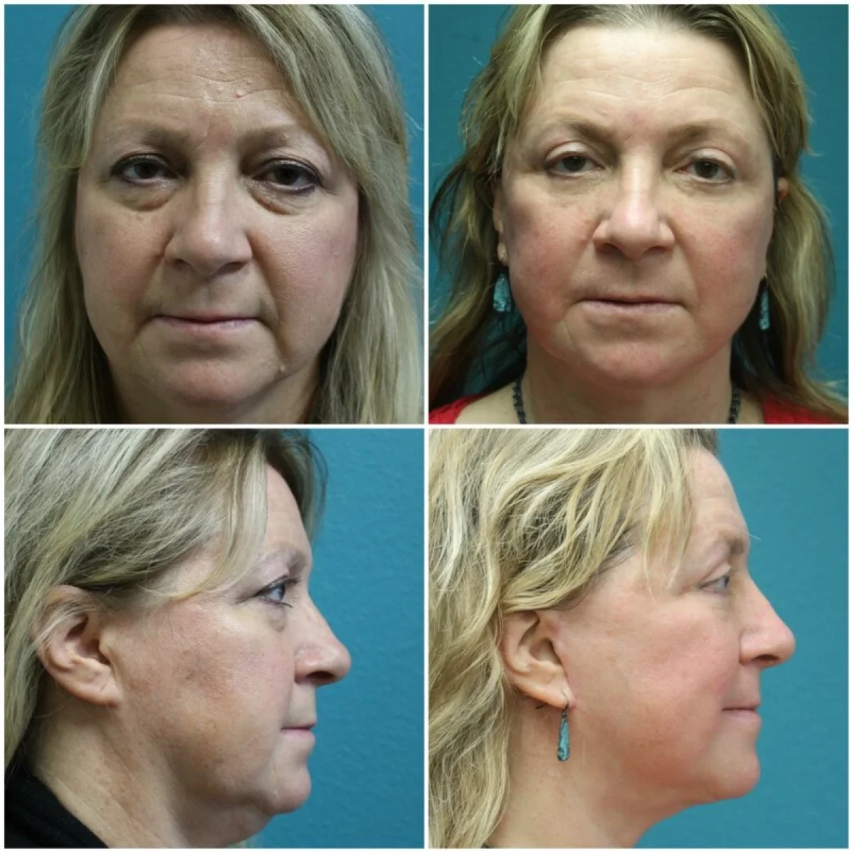 Before and After Rhinoplasty