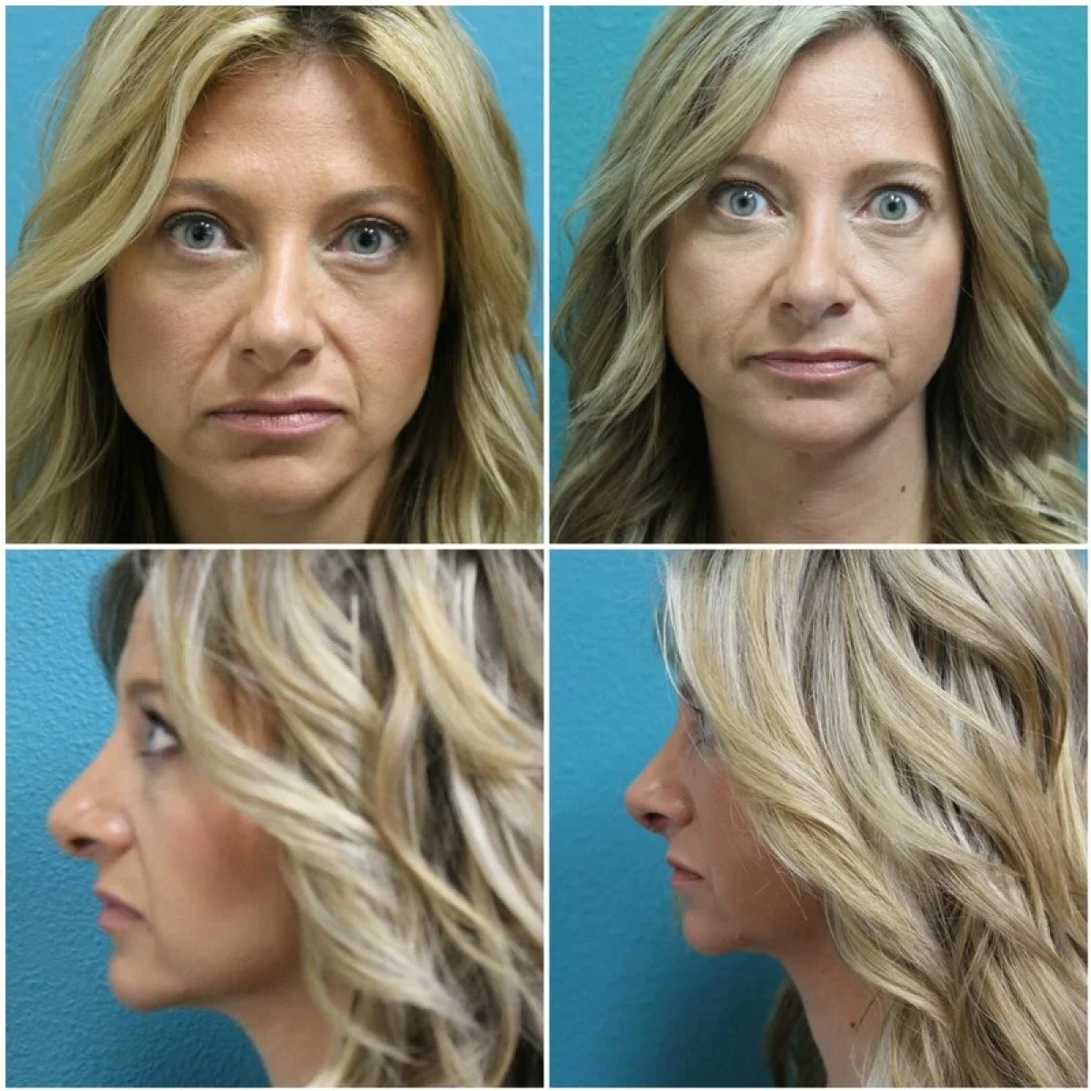 Before and After Rhinoplasty