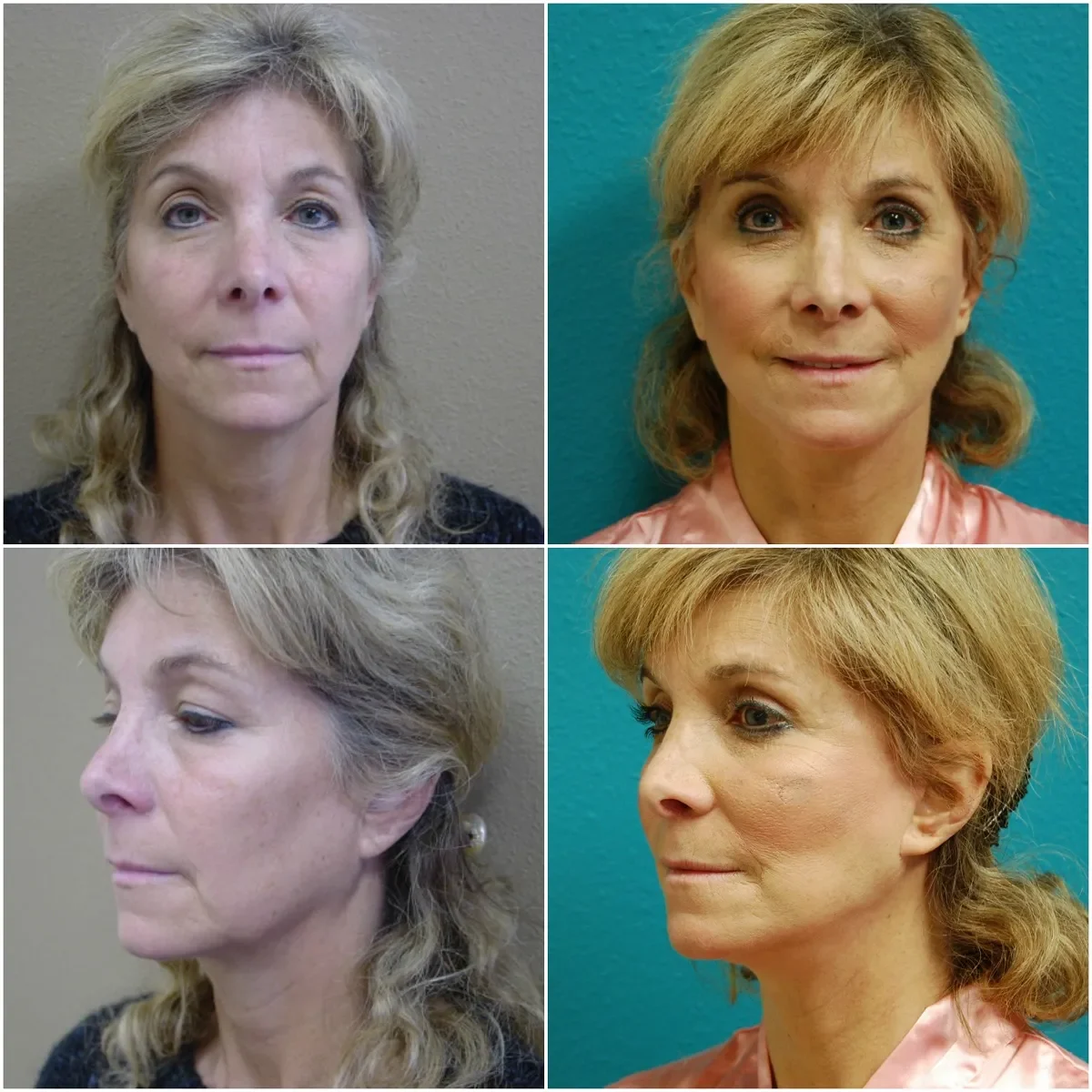Before and after Facelift blepharoplasty