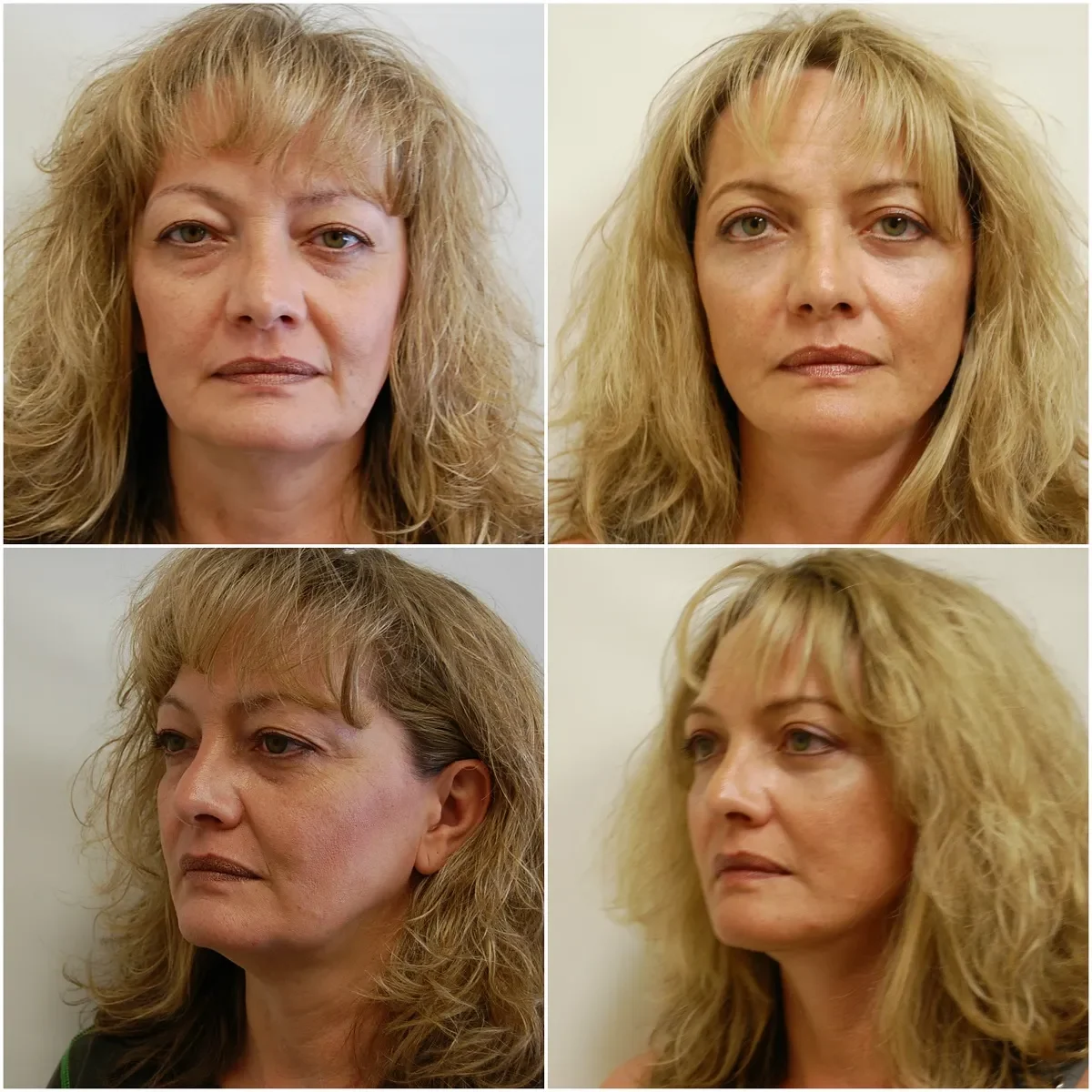 Before and after Facelift blepharoplasty