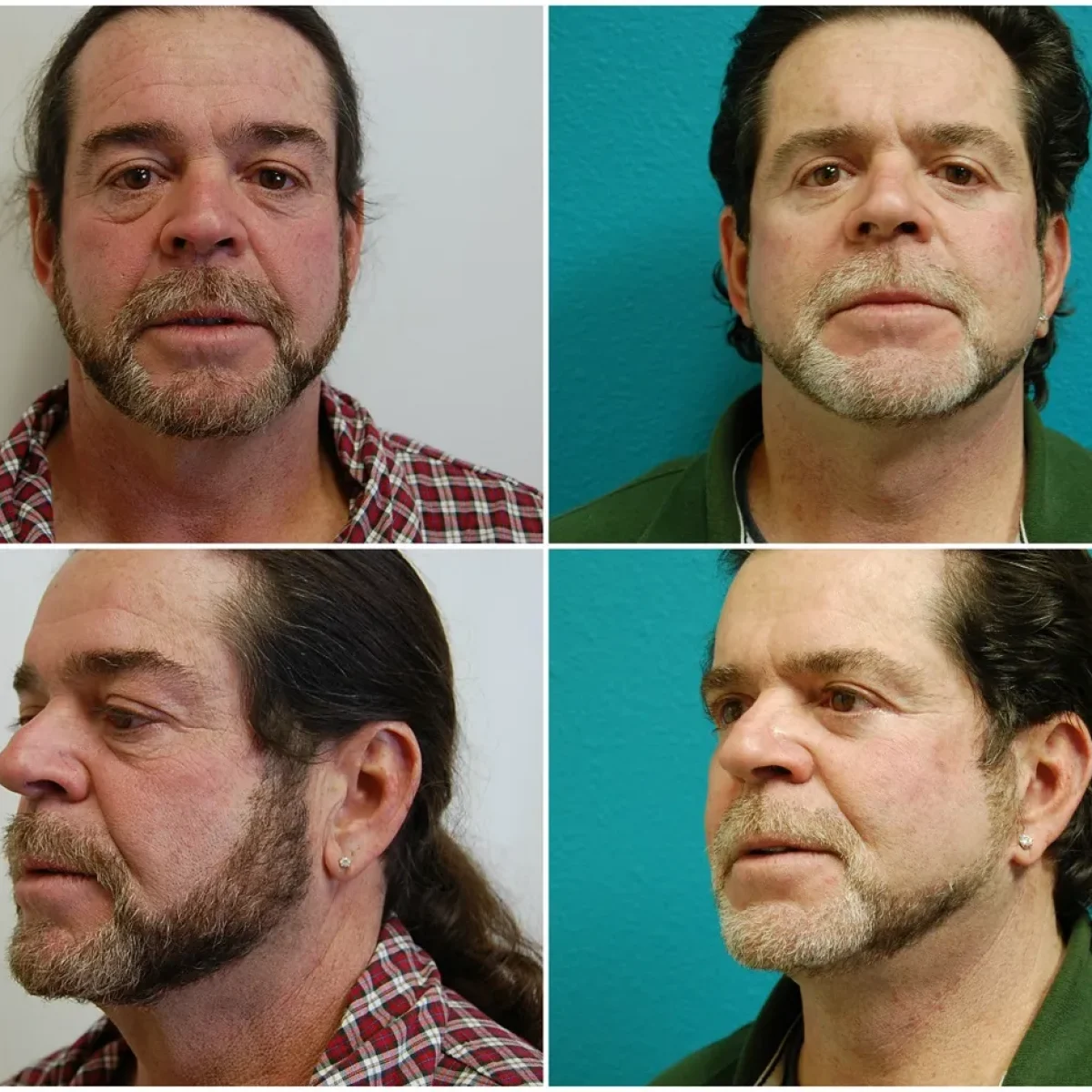 Before and after Facelift blepharoplasty