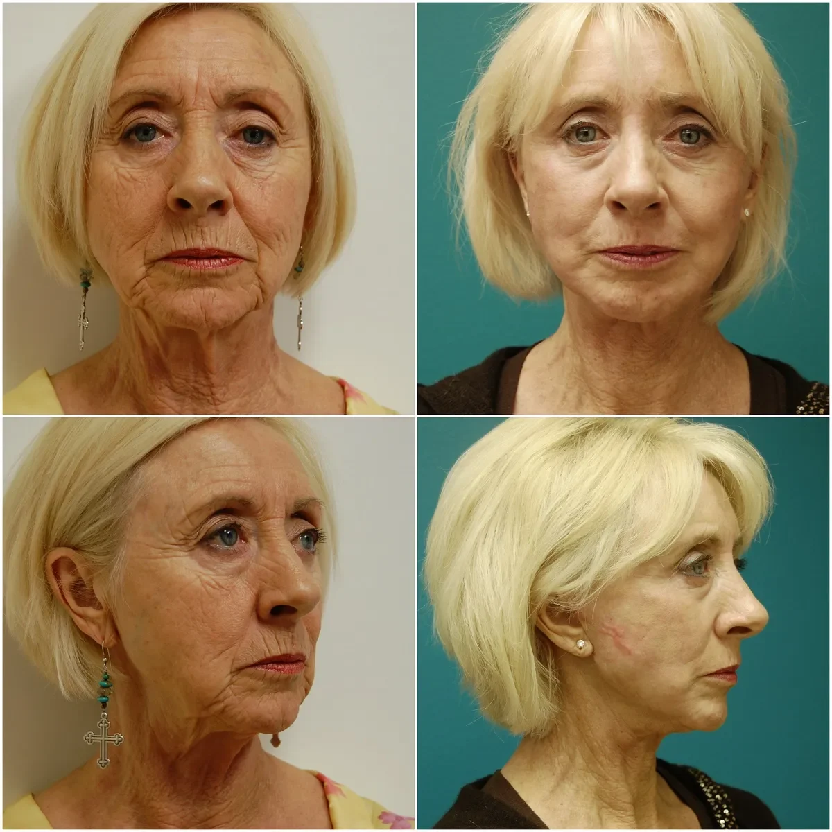 Before and after Facelift blepharoplasty