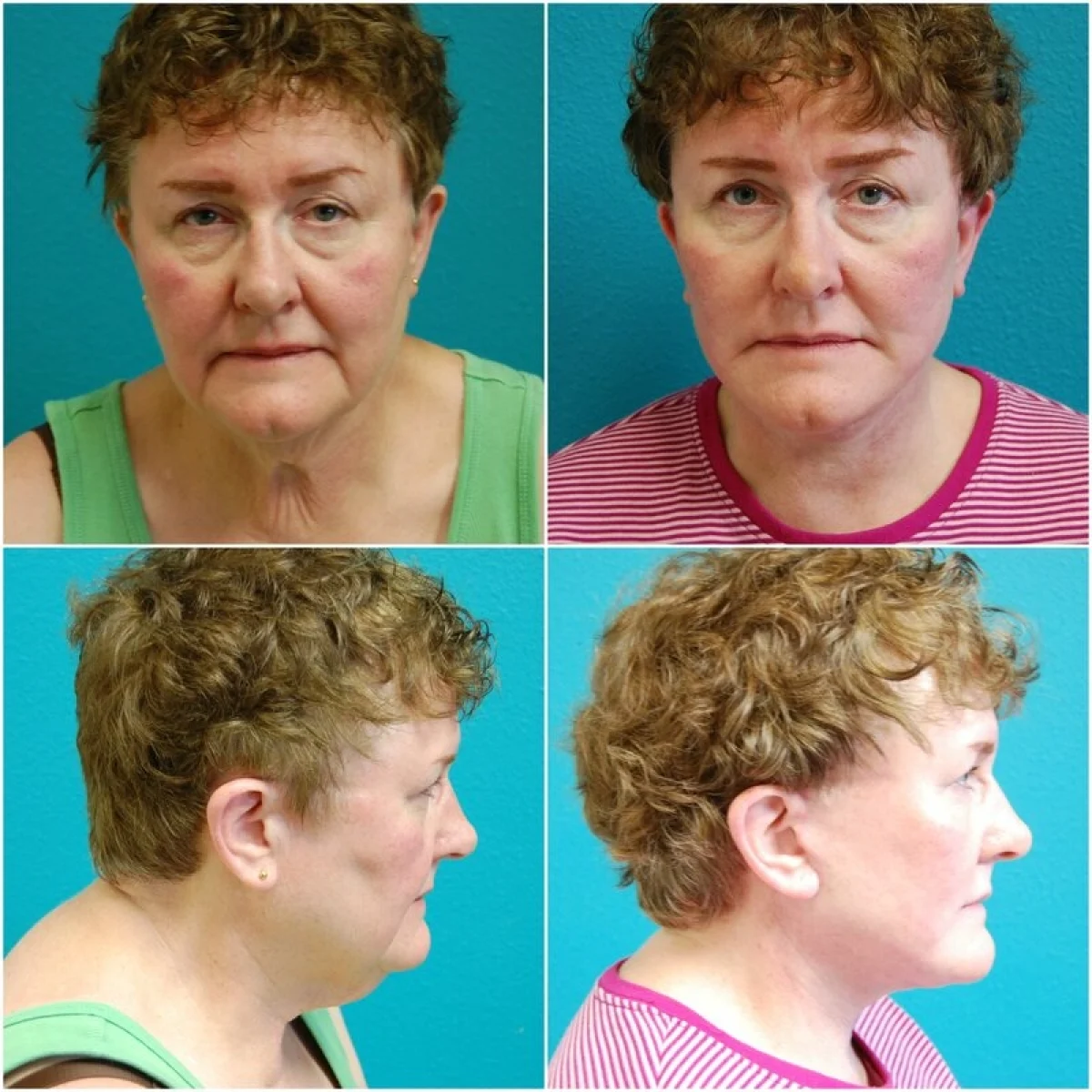 Before and after Facelift blepharoplasty