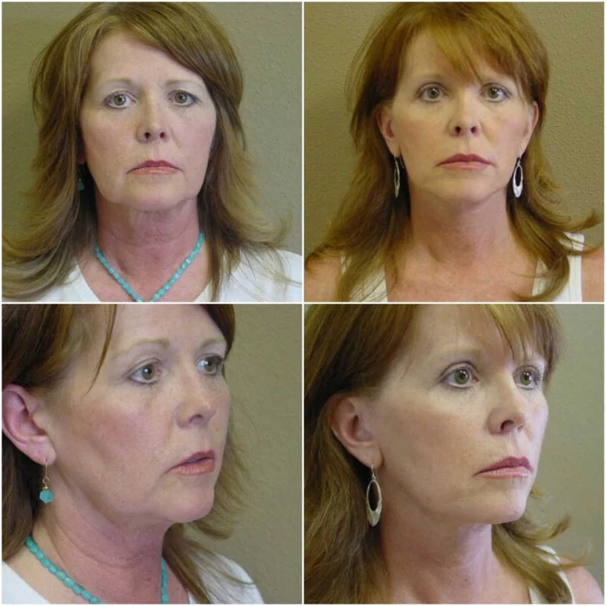 Before and after Facelift blepharoplasty
