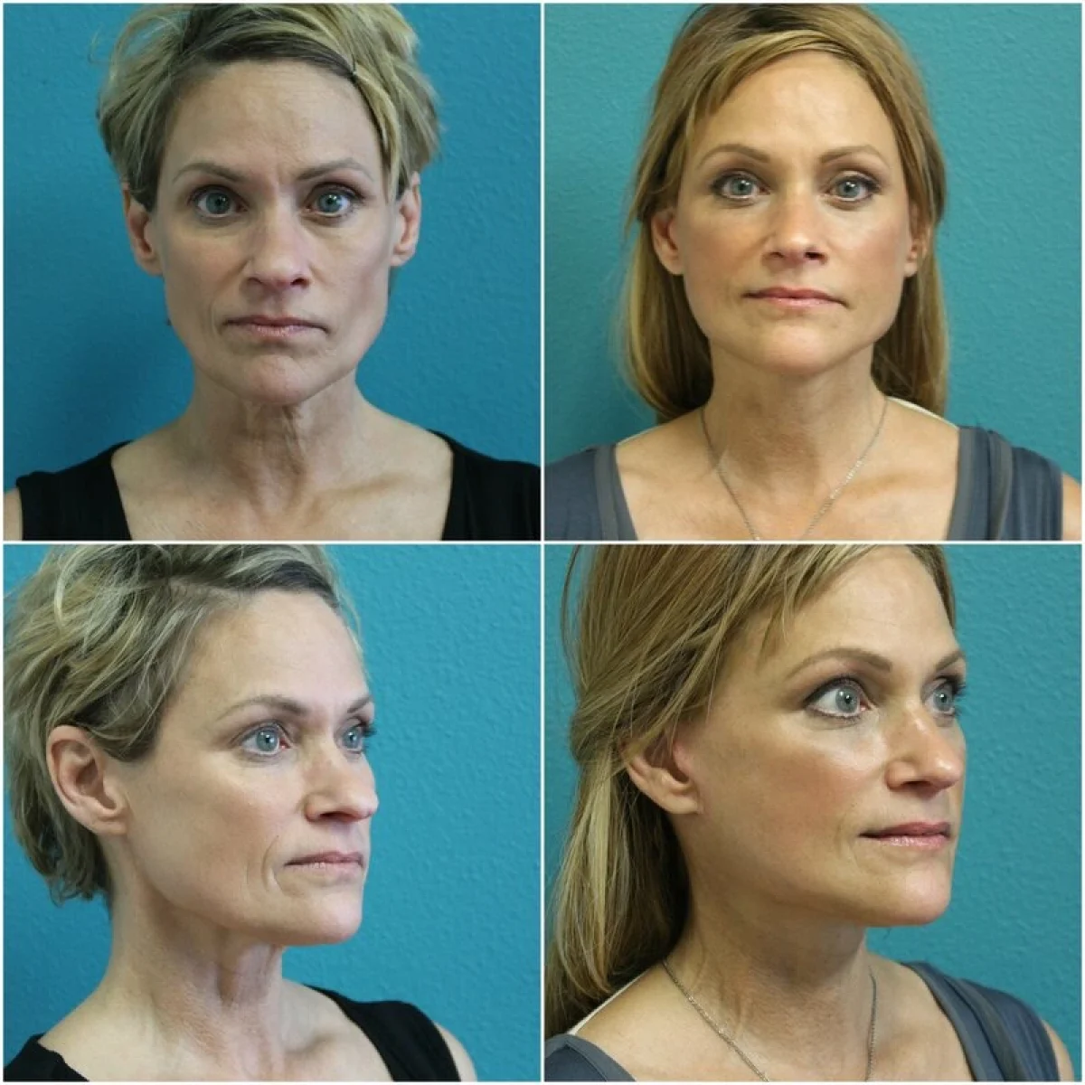 Before and after Facelift blepharoplasty