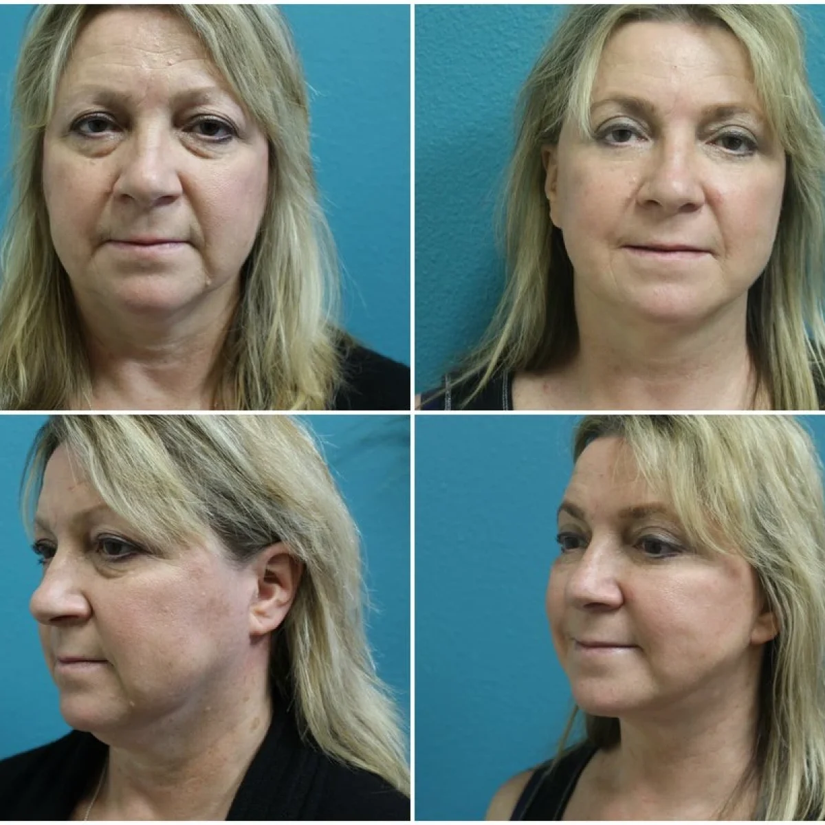 Before and after Facelift blepharoplasty