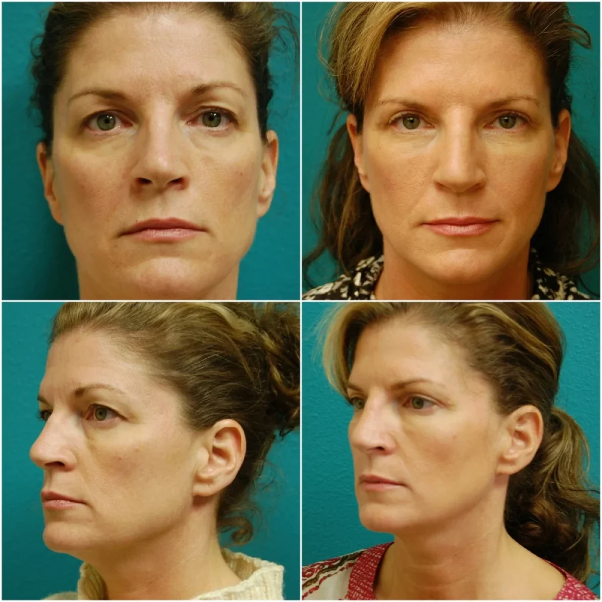Before and After Rhinoplasty