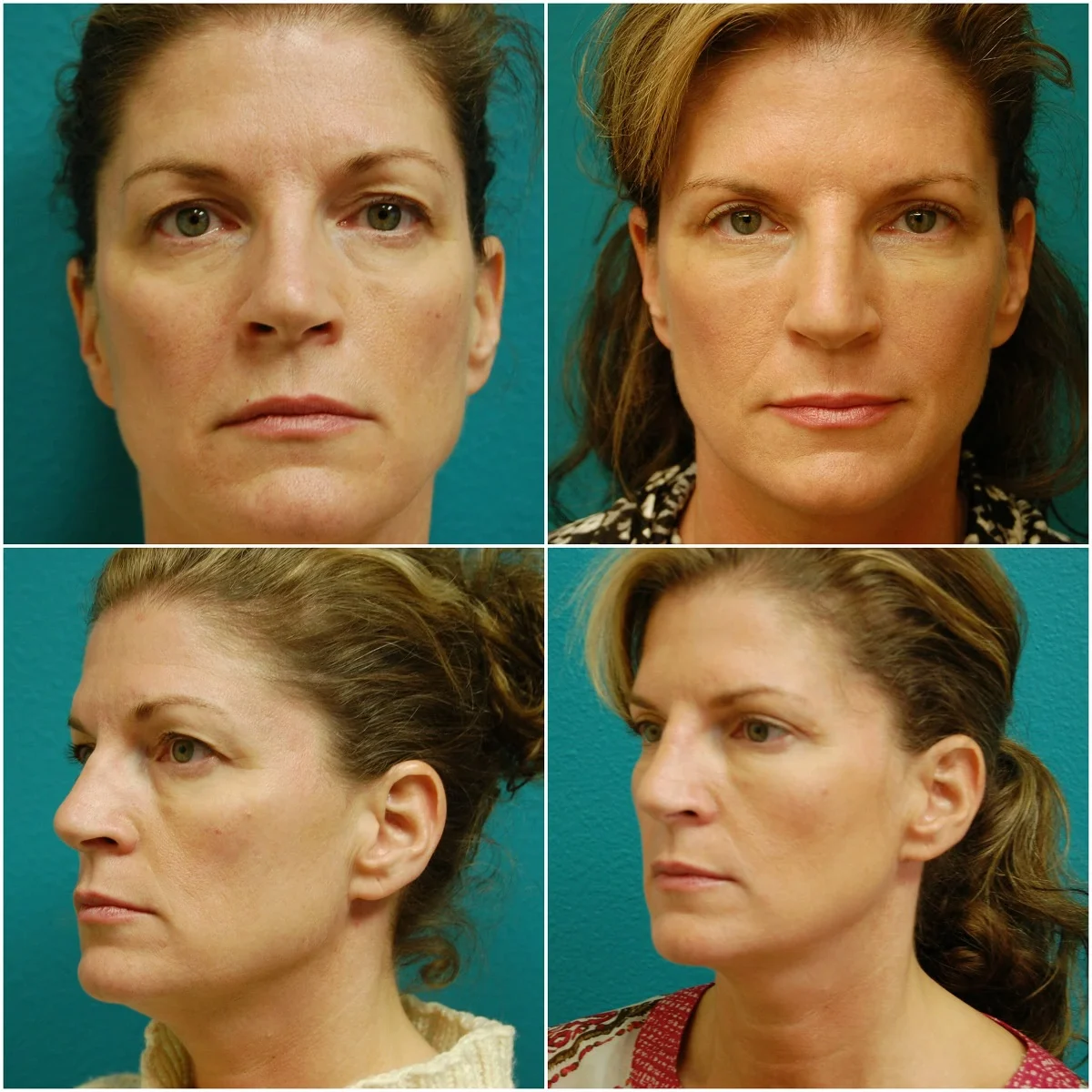 Before and After Rhinoplasty