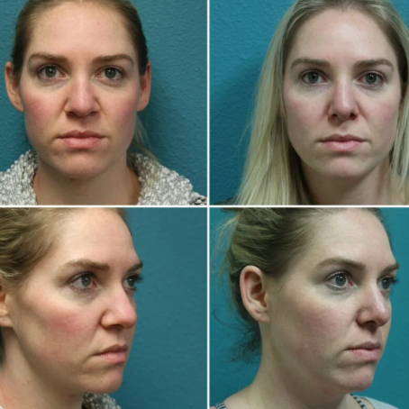 Before and after result
