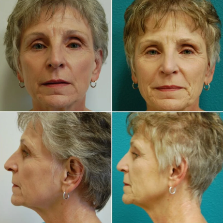 Before and after result
